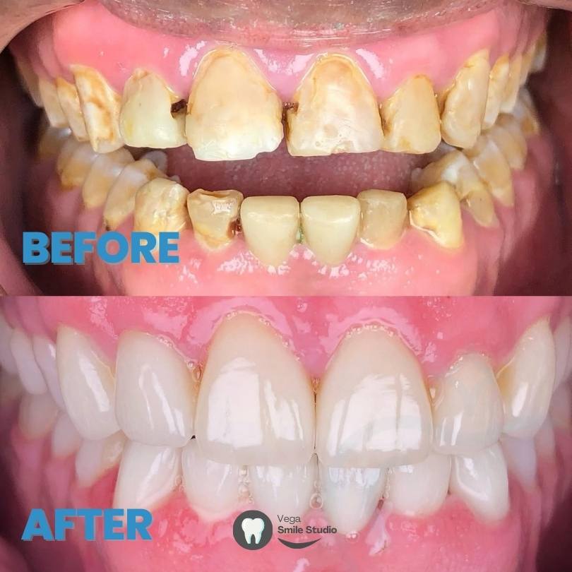 Dental Crowns boca raton